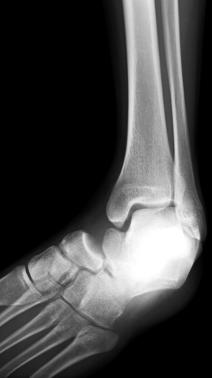 Figure 2 for case Medial subtalar joint dislocation( RID3029 )